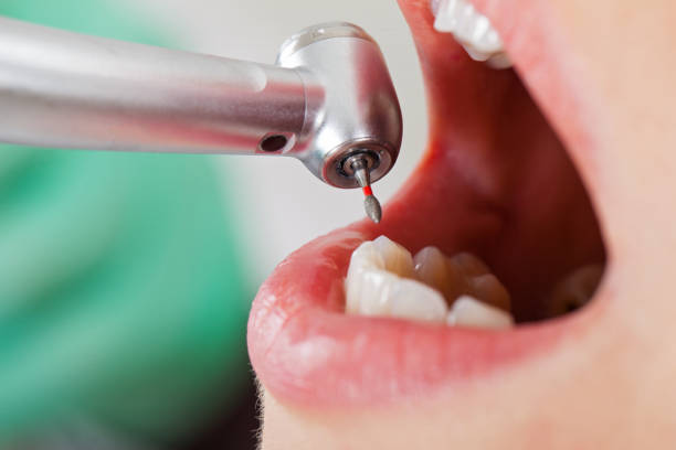 Best Knocked-Out Tooth (Avulsed Tooth) Treatment in North Mankato, MN